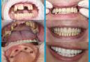 Как избежать конфуза с потерей съемного зубного протеза